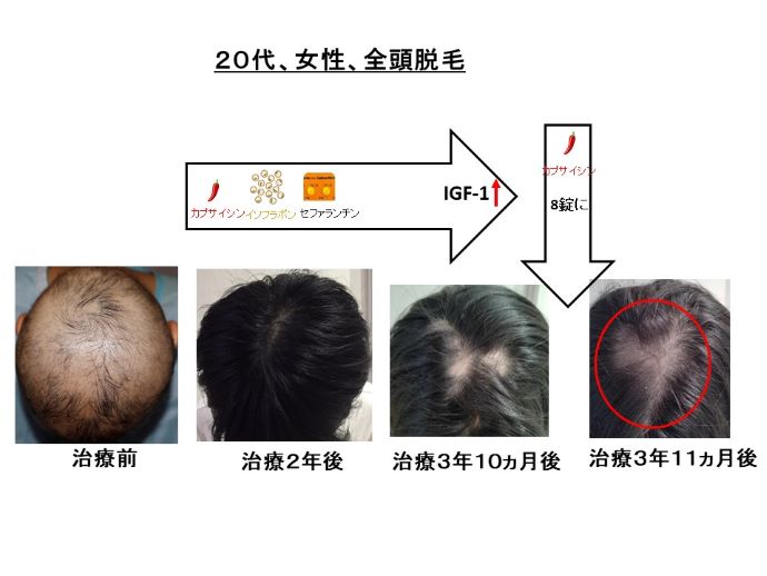 円形脱毛症　病院